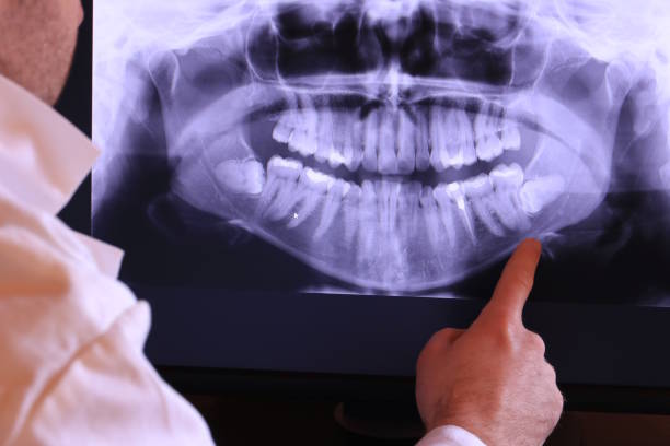 Best Emergency Wisdom Teeth Removal in Winnebago, MN